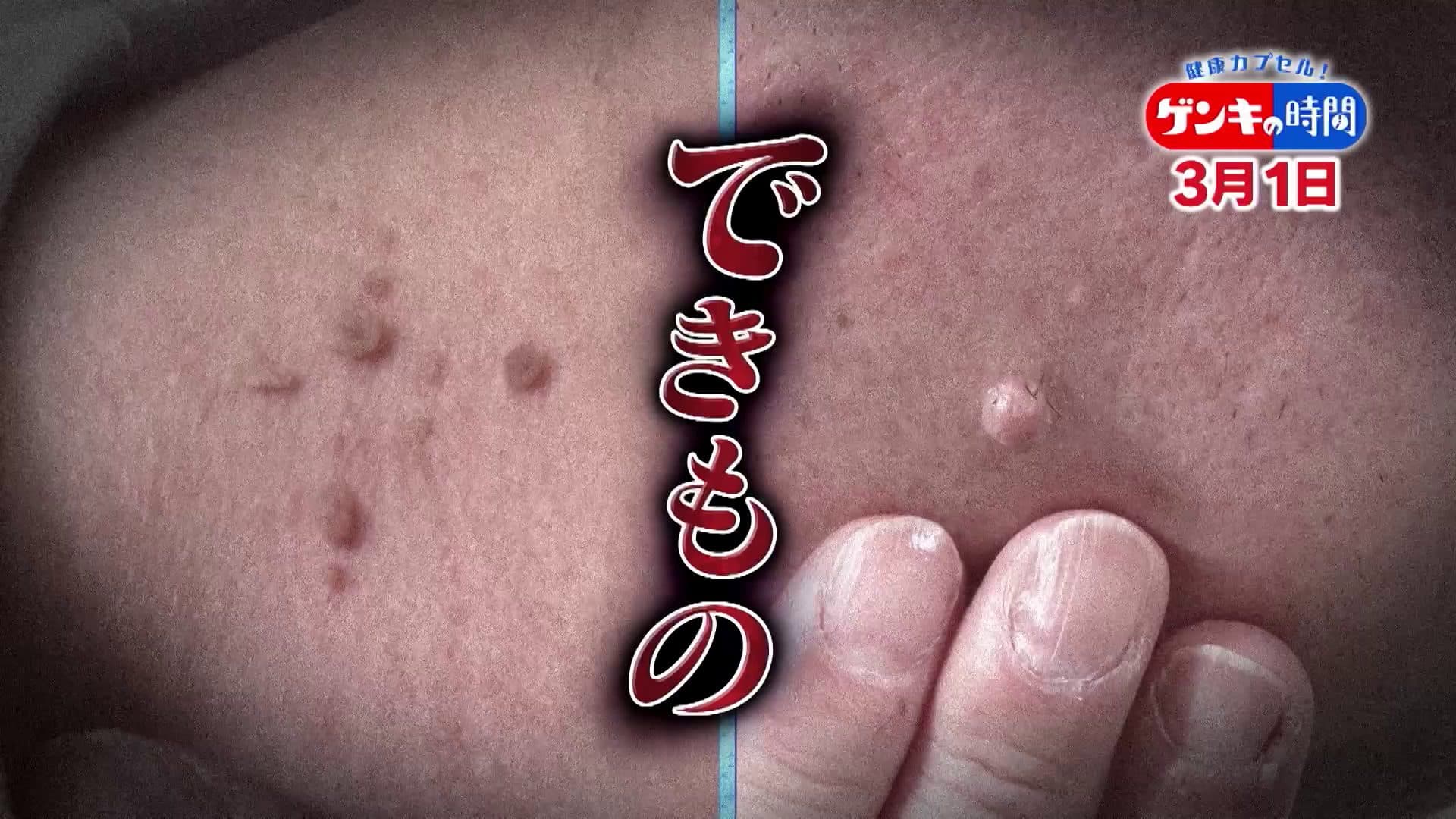 「 悪性のできもの 」 見分けるポイント …「 皮膚の変化 」 見逃すと危険 ！ 専門医に学ぶ ！ 悪性のできもの  のサイン | CBC MAGAZINE （ CBCマガジン ）