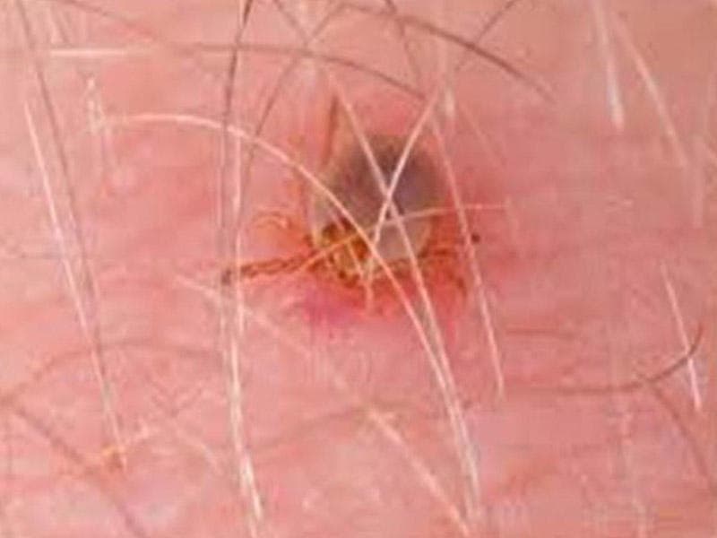 Gənə bu Avropa ölkəsini cənginə aldı - 185 rayon təhlükədədir