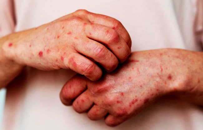 Suma Nuevo León 35 casos de sarampión ; esperan contener brote – Periódico Zócalo | Noticias de Saltillo , Torreón , Piedras Negras , Monclova , Acuña