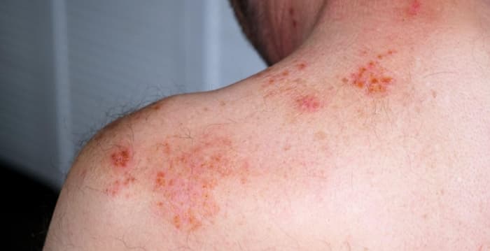 壓力引發皮膚病 中醫師教你改善方法 | 壓力 , 皮膚病