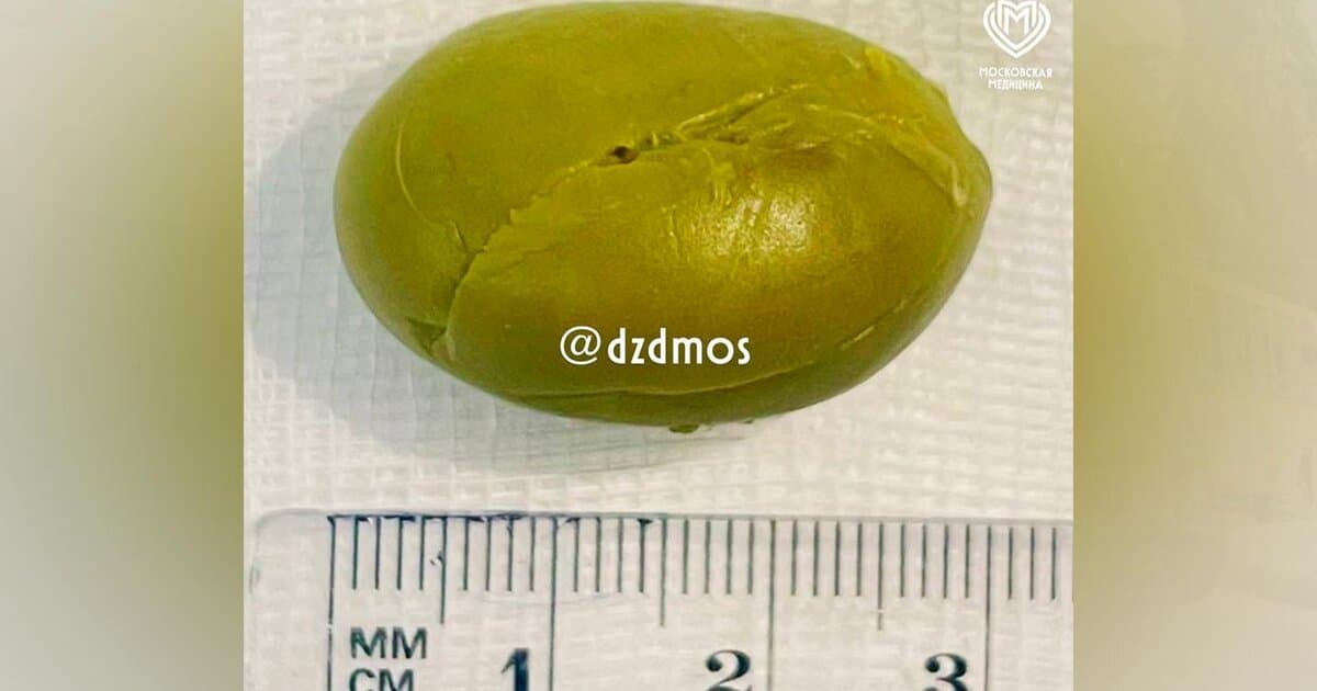 Врачи в Москве спасли ребенка , у которого в желудке застряла оливка