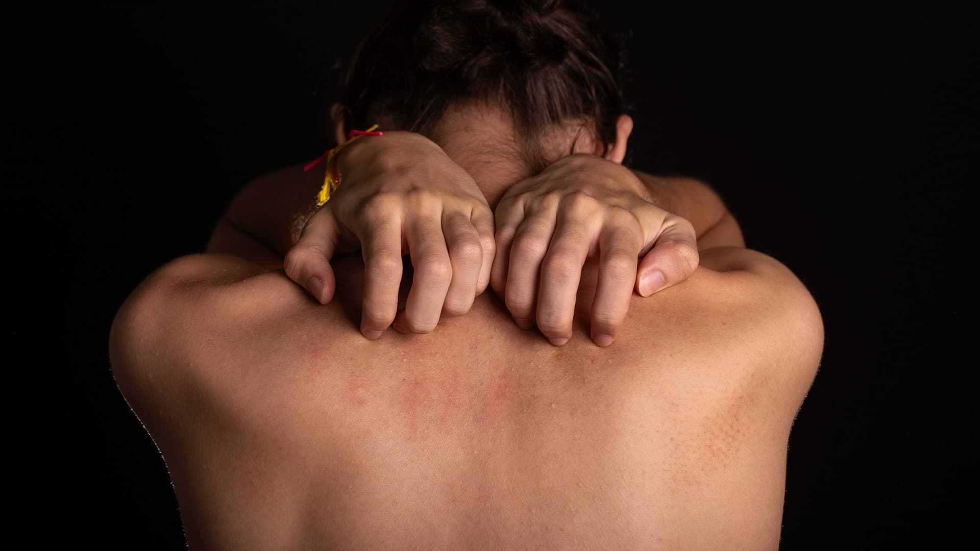 Έρπης Ζωστήρας : 1 στους 3 ενήλικες θα νοσήσει – Ποιες ηλικίες « χτυπάει » η νόσος